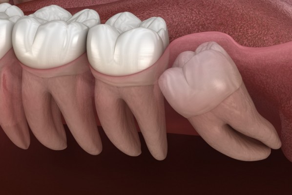 Weisheitszähne im Kiefer