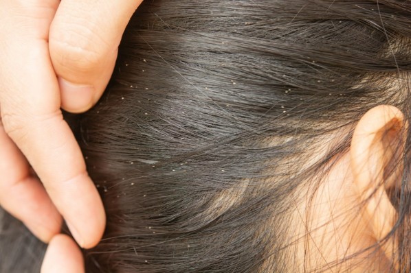 Kopflausbefall bei einer Person mit dunklen Haaren.
