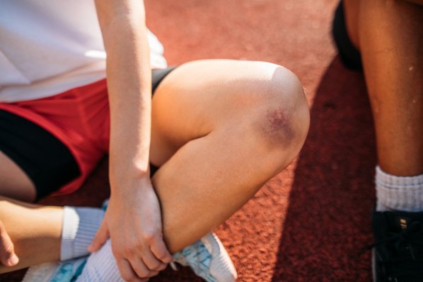 Sportler mit blauem Fleck am Knie, die auf einem Sportplatz sitzt
