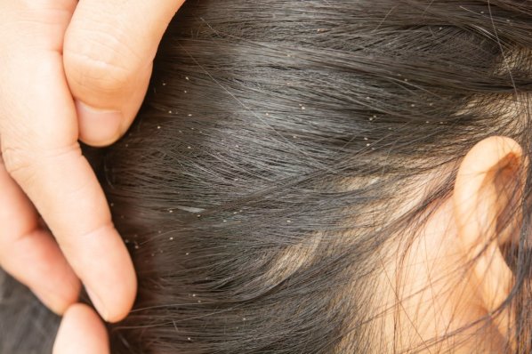 Kopflausbefall bei einer Person mit dunklen Haaren.
