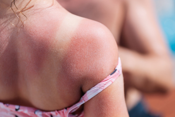 Sonnenbrand auf dem Rücken eines Mädchens