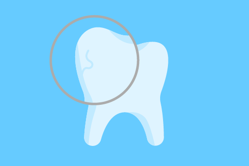 Freiliegende Zahnhälse und feine Risse im Zahn werden speziell poliert und versiegelt.
