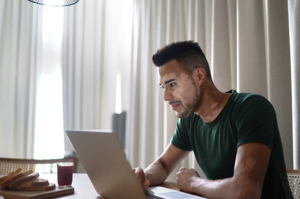 Junger Mann mit Vitiligo am laptop