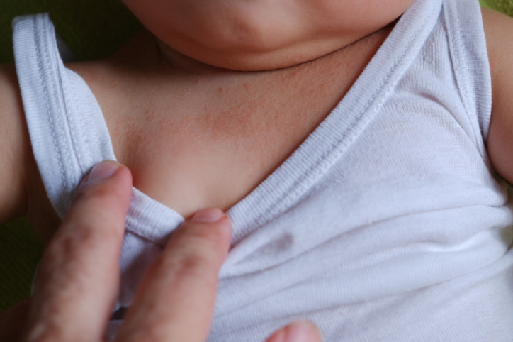 Ein Baby mit Hitzepickeln am Hals.