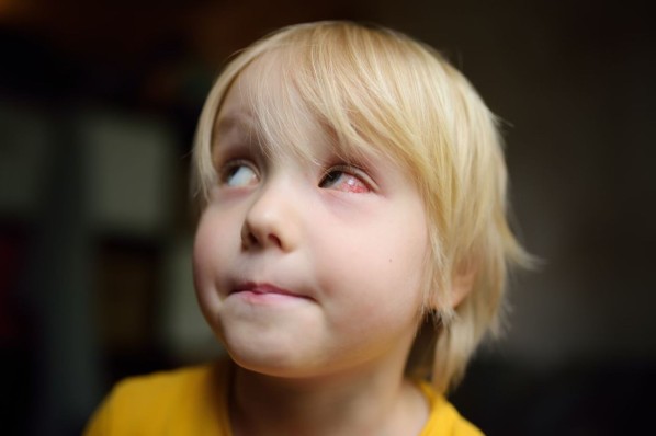 Preschooler boy with red bursted blood vessels in eye. Conjunctivitis, trauma of eye, inflammation, infection, allergy or intraocular pressure are reason for contacting an ophthalmologist. Kids health