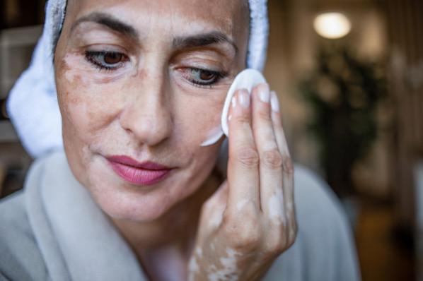 Reife Frau mit Vitiligo pflegt ihre Gesichtshaut