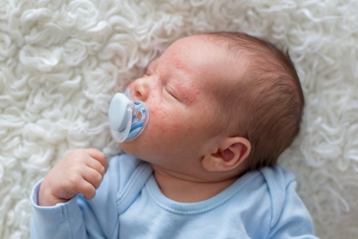 Ein Baby mit Neugeborenenakne.