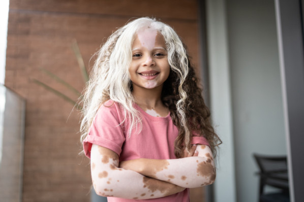 junges Mädchen mit hellen hautflecken und weißen Haarsträhnen