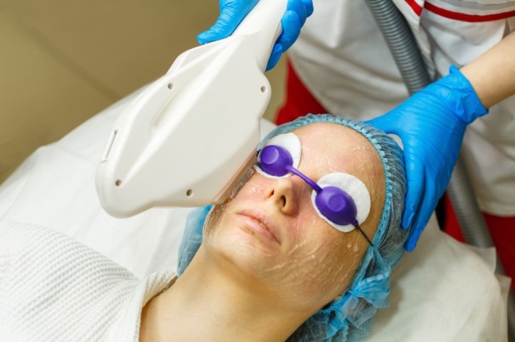 Bei einer Frau wird eine Laserbehandlung im Gesicht durchgeführt