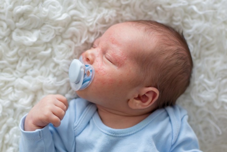 Ein Baby mit Neugeborenenakne.
