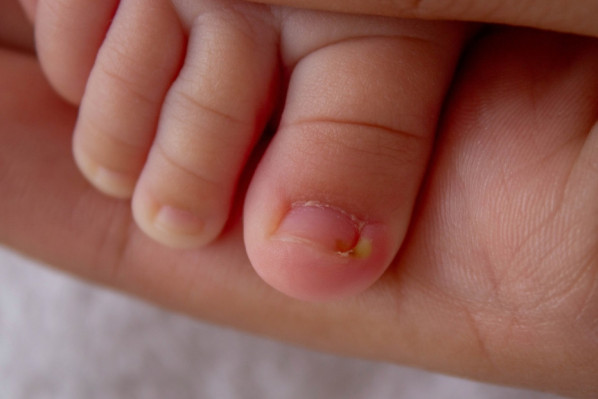 Ein Zeh von einem Baby mit Eiter am Fußnagel