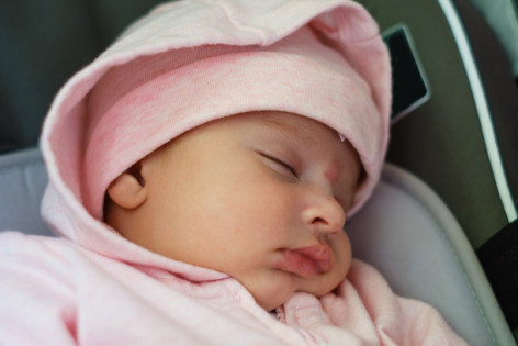 Ein Baby mit Storchenbiss an der Stirn