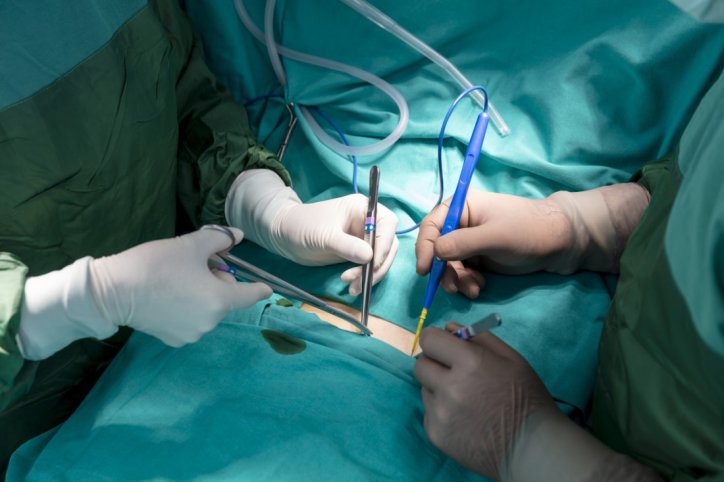 Eine Dopaminpumpe wird mittels Operation eingesetzt
