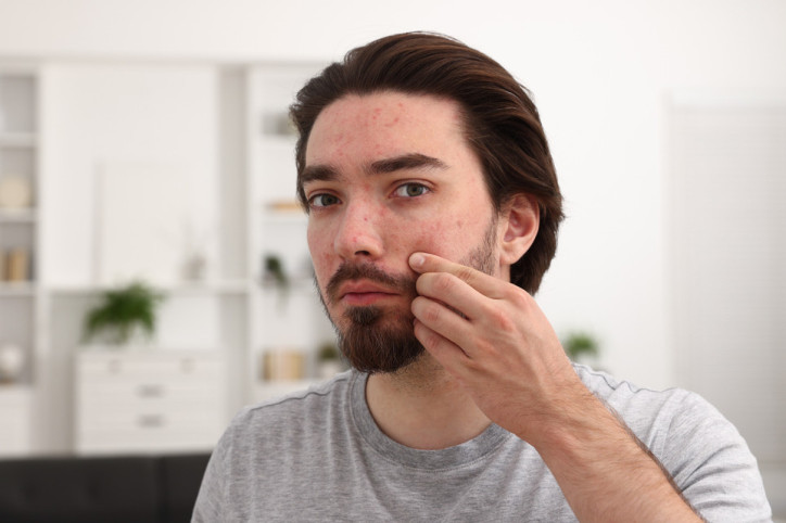 Ein etwa 25 jähriges Frau sitzt vor einem kleinen Spiegel und drückt einen Pickel aus.