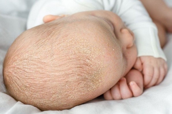 seborrheic dermatitis crusts on the baby's head. child with seborrhea in the hair, newborn skin problems