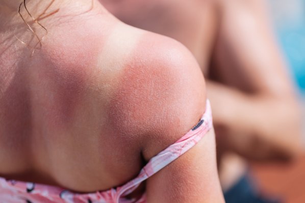 Sonnenbrand auf dem Rücken eines Mädchens
