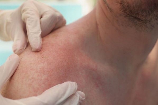 Die Schulter einer Person wird auf Hautirritationen untersucht.