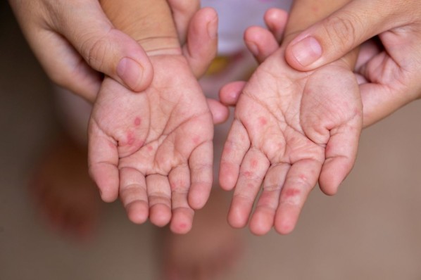 Eltern halten die Hände eines Kindes mit Hand-Muss-Fuß