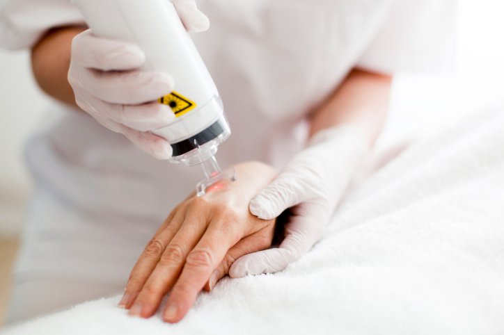 Rubinflecken auf der Hand werden mit einem Laser entfernt