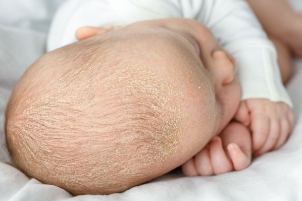 Milchschorf auf dem Kopf eines Babys