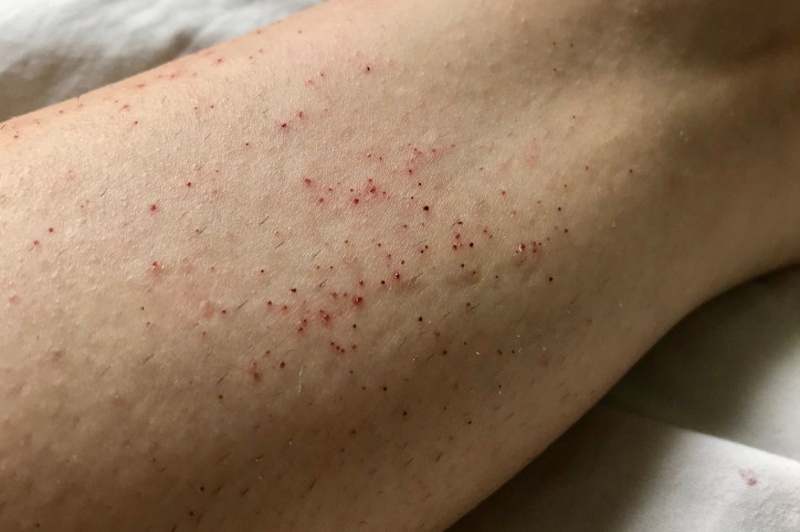 Frisch rasiertes Bein mit Rasurbrand.