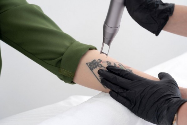 Auf dem Arm einer jungen Frau wird ein unerwünschtes Tattoo mittels Laser entfernt. 