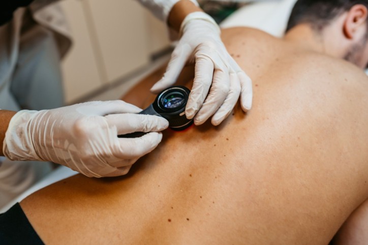 Untersuchung von Muttermalen auf dem Rücken, um Anzeichen von Hautkrebs zu erkennnen.